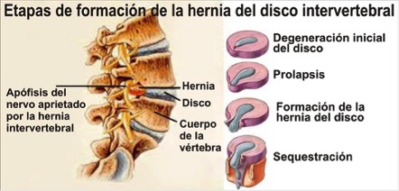 HERNIAS DISCALES 